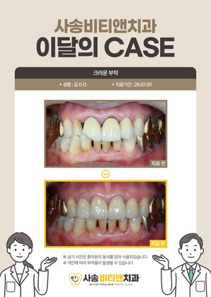 크라운 부착