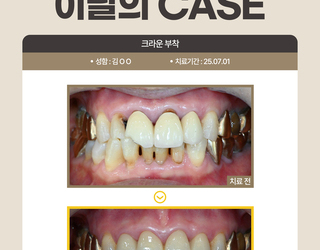 크라운 부착
