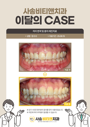 치아 변색 및 충치 레진치료