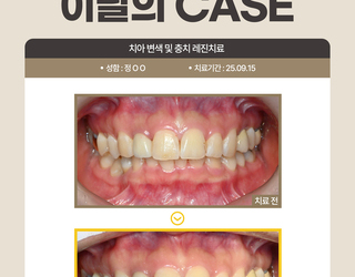 치아 변색 및 충치 레진치료