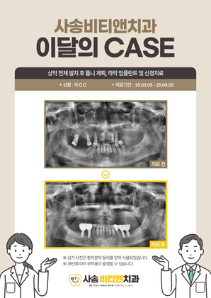 상악 전체 발치 후 틀니 계획, 하악 임플란트 및 신경치료