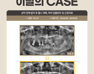 상악 전체 발치 후 틀니 계획, 하악 임플란트 및 신경치료