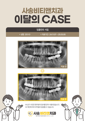 임플란트 식립