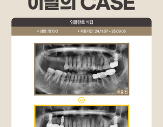 임플란트 식립