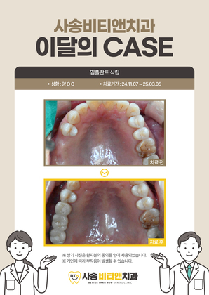 임플란트 식립