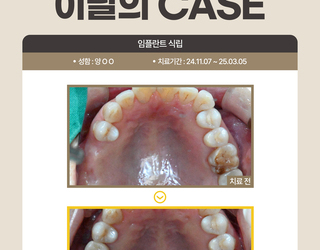 임플란트 식립