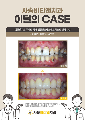심한 충치로 무너진 치아, 임플란트와 보철로 복원한 전악 재건