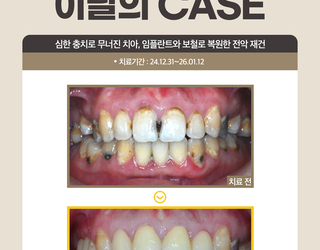 심한 충치로 무너진 치아, 임플란트와 보철로 복원한 전악 재건