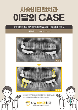 하악 기본브릿지 제거 후 임플란트 & 상악 신경치료 후 크라운