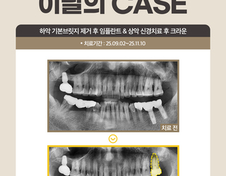 하악 기본브릿지 제거 후 임플란트 & 상악 신경치료 후 크라운
