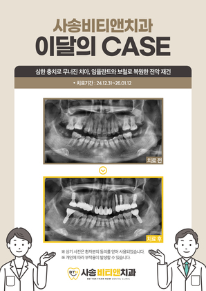 심한 충치로 무너진 치아, 임플란트와 보철로 복원한 전악 재건