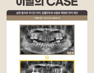 심한 충치로 무너진 치아, 임플란트와 보철로 복원한 전악 재건