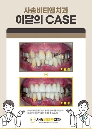 심한 충치로 상한 앞니, 브릿지치료로 심미성과 기능 회복