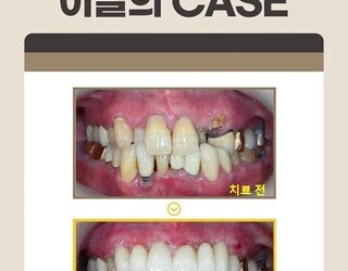 심한 충치로 상한 앞니, 브릿지치료로 심미성과 기능 회복