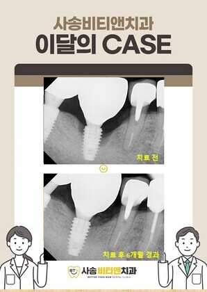 오래 전 타치과 임플란트 주변 염증. 잇몸치료와 뼈이식으로 해결. 임플란트도 관리가 필요합니다.