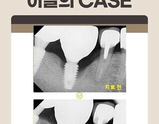 오래 전 타치과 임플란트 주변 염증. 잇몸치료와 뼈이식으로 해결. 임플란트도 관리가 필요합니다.