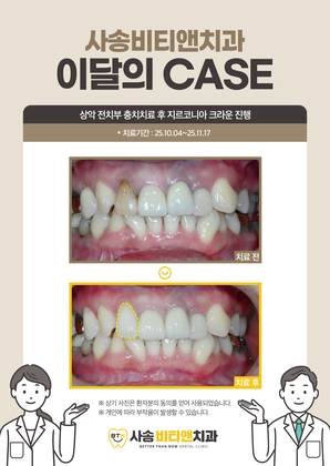 상악 전치부 충치치료 후 지르코니아 크라운 진행