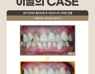 상악 전치부 충치치료 후 지르코니아 크라운 진행
