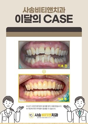 치주염으로 흔들리는 앞니, 브릿지치료로 심미성과 기능회복