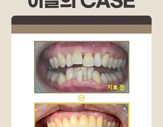 치주염으로 흔들리는 앞니, 브릿지치료로 심미성과 기능회복